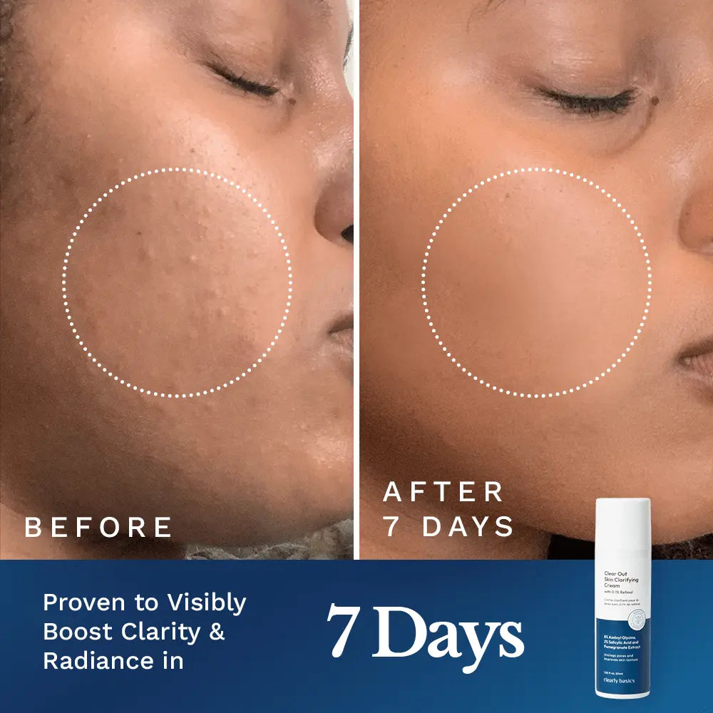 Clear Out Skin Clarifying Cream