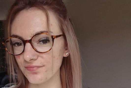 Dealing With Scars - Clearly Basics