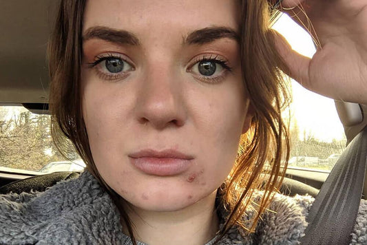 Teacher Who Spent Thousands Battling Hormonal Cystic Acne Finally Finds a Lasting Solution with Clearly - Clearly Basics