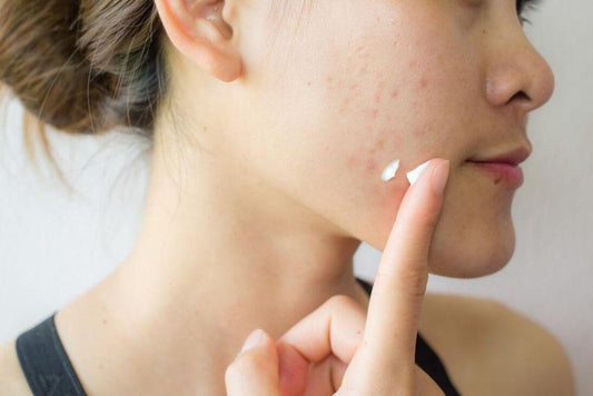 A Fast and Effective Way to Get Rid of Pimples - Clearly Basics