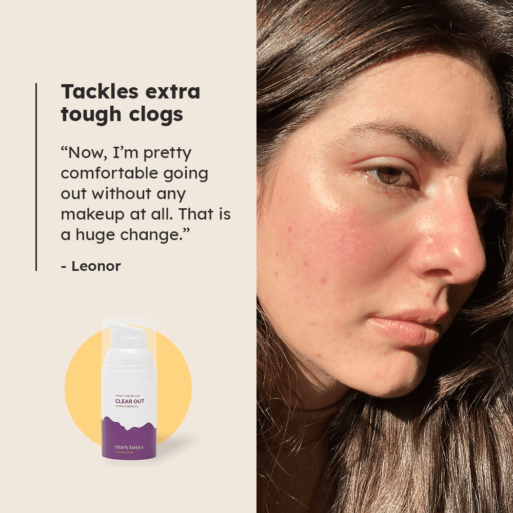 Clear Out Extra Strength Clarifying Lotion - Clearly Basics