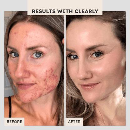 Clear Out Extra Strength Clarifying Lotion - Clearly Basics