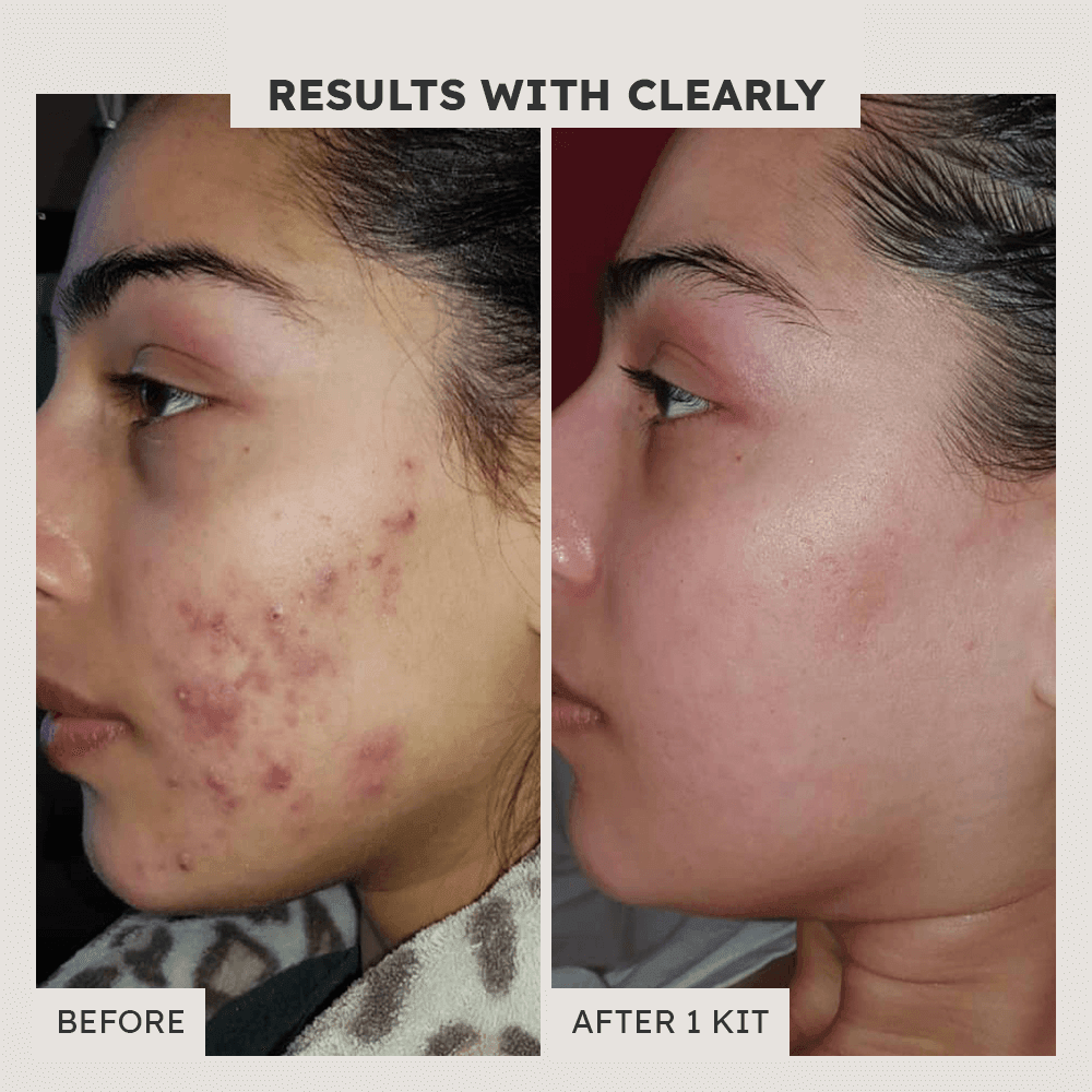 Dark Mark Defense Correction Gel - Clearly Basics