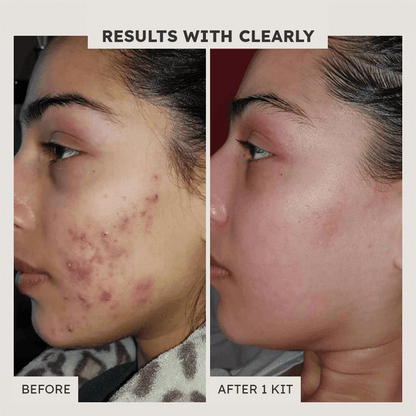 Dark Mark Defense Correction Gel - Clearly Basics