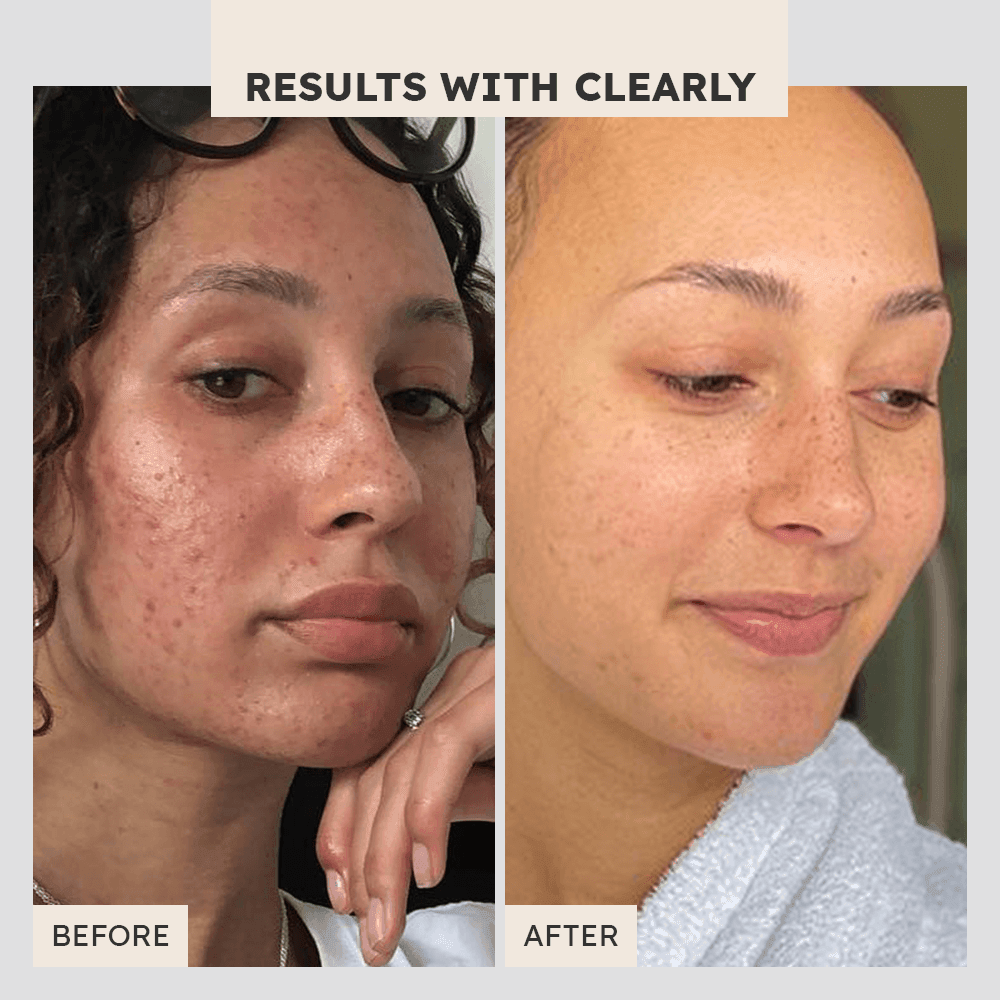 Lighten Up Redness Rescue Cream - Clearly Basics