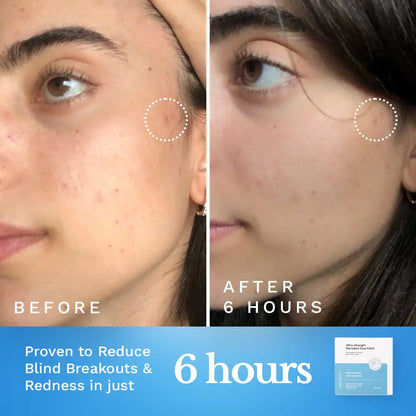 Ultra-Strength Microdart Acne Patch