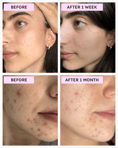 Alpha Poly Micro Peel Pads