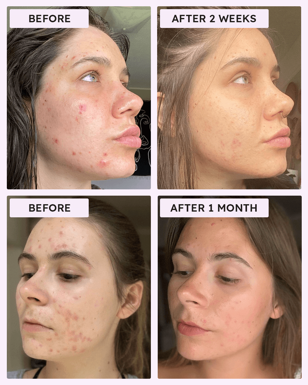 Ultra-Strength Microdart Acne Patch – Clearly Basics